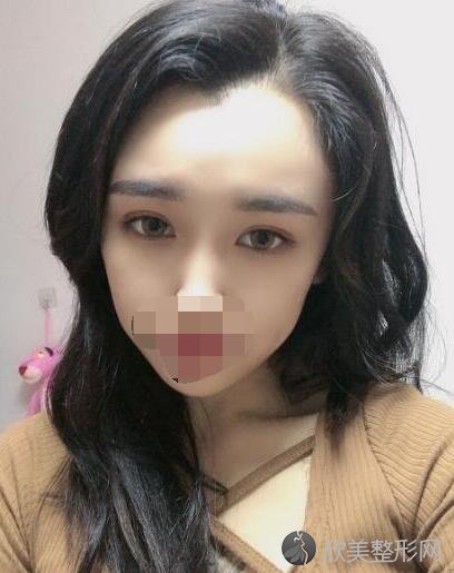 双眼皮术后20天