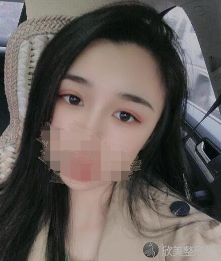 双眼皮术后30天