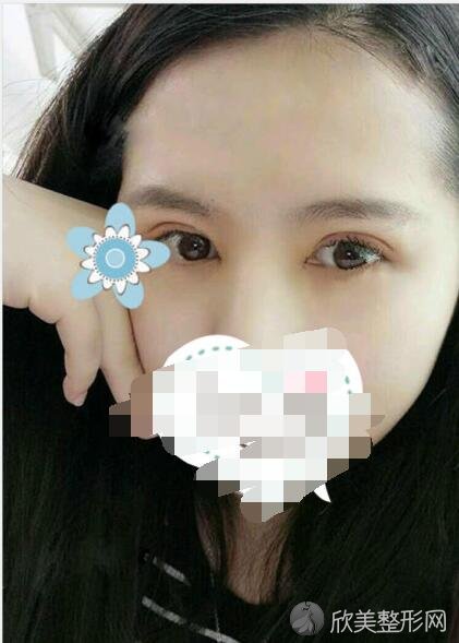 双眼皮术后20天