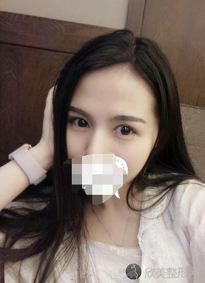 双眼皮术后30天