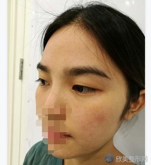 双眼皮术前