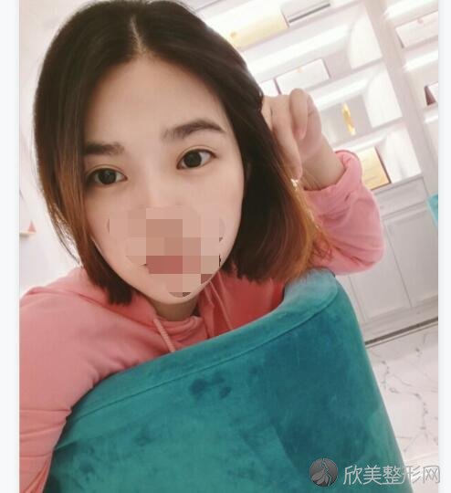 双眼皮术后30天