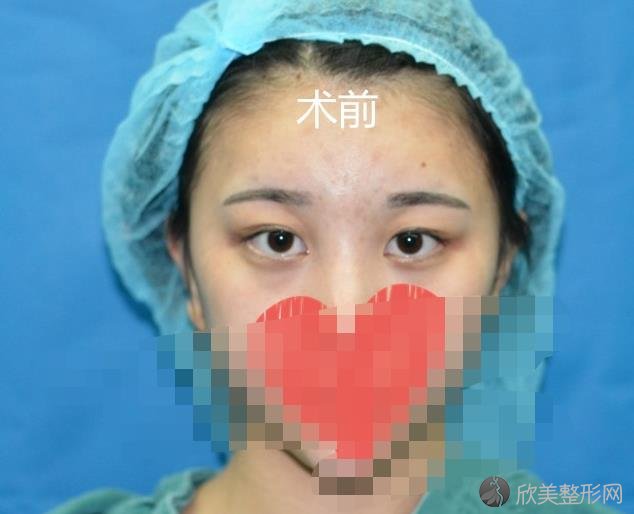 北京艾玛整形美容医院李方奇医生做双眼皮之前