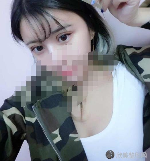 北京艾玛整形美容医院李方奇医生做双眼皮之后