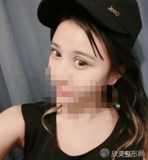 北京艾玛整形美容医院李方奇医生做双眼皮之后