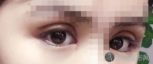 北京爱悦丽格整形美容医院马医生做双眼皮之后