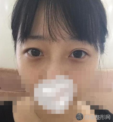 北京爱悦丽格整形美容医院马力医生做双眼皮之前