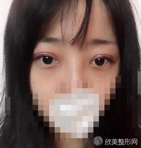 北京爱悦丽格整形美容医院马力医生做双眼皮之后