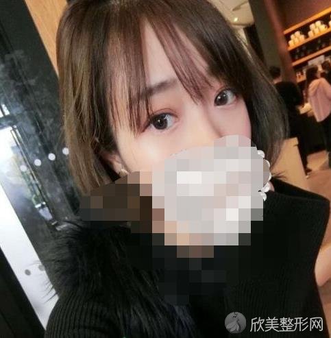 北京爱悦丽格整形美容医院马力医生做双眼皮之后