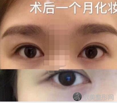 北京东方百合整形美容医院王世勇医生做双眼皮之后