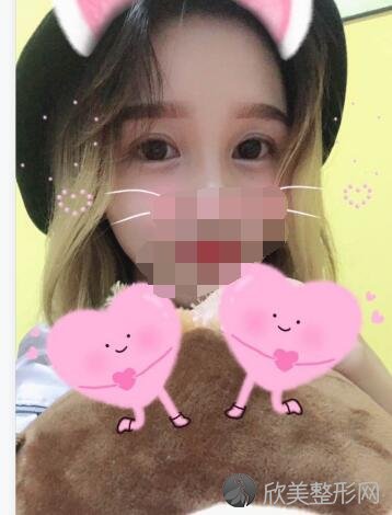 双眼皮术后20天