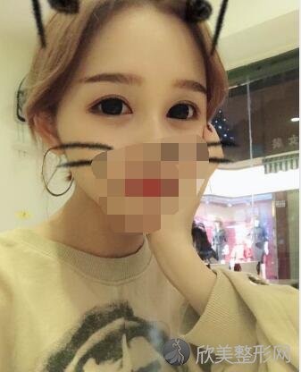 双眼皮术后30天