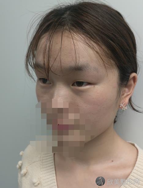 北京东方百合整形美容医院王世勇医生开眼角之前