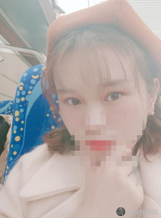 北京东方百合整形美容医院王世勇医生开眼角之后