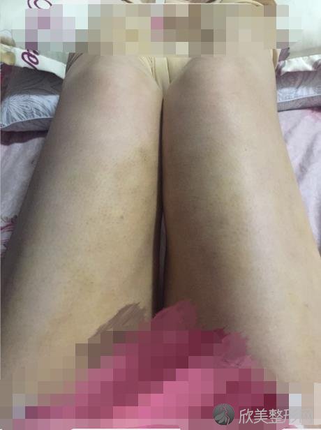 北京东方和谐整形美容医院冯斌医生做吸脂之后