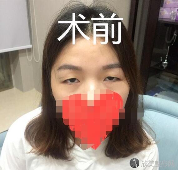 双眼皮术前