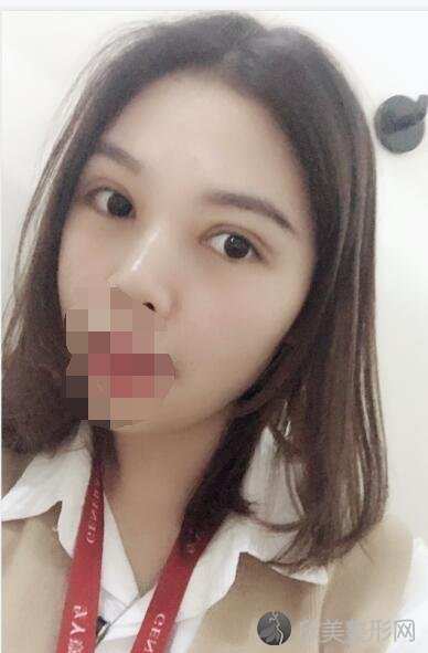 双眼皮术后30天
