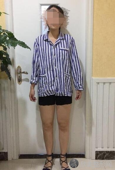 大腿吸脂术前