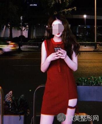 大腿吸脂术后20天