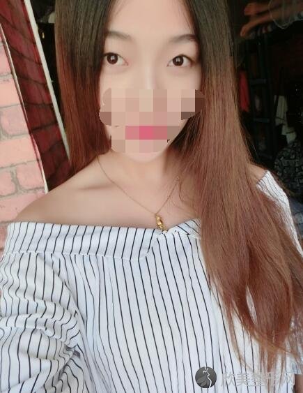 双眼皮术前