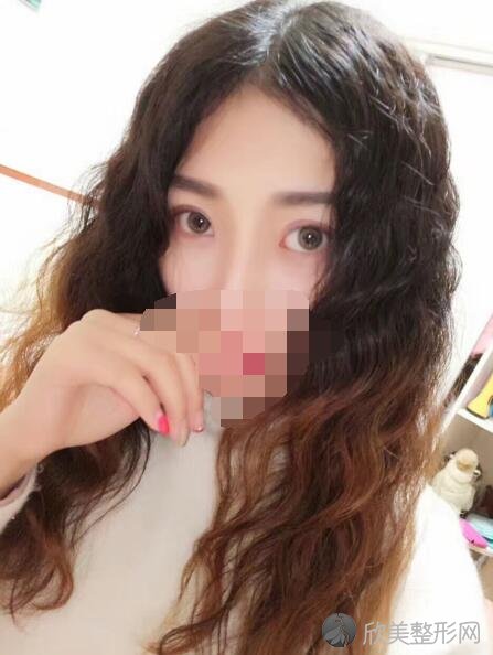 双眼皮术后20天
