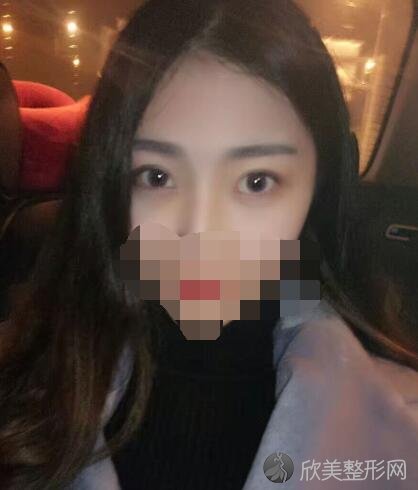 双眼皮术后30天
