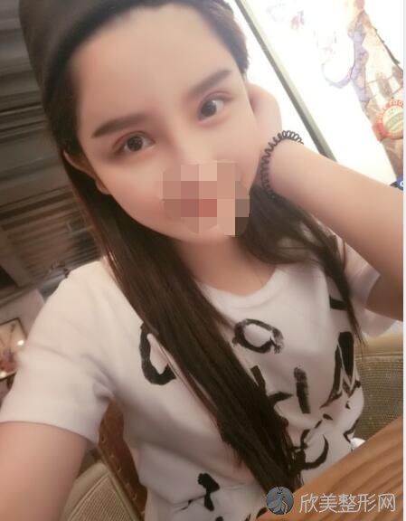 双眼皮术后20天