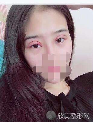双眼皮术后20天