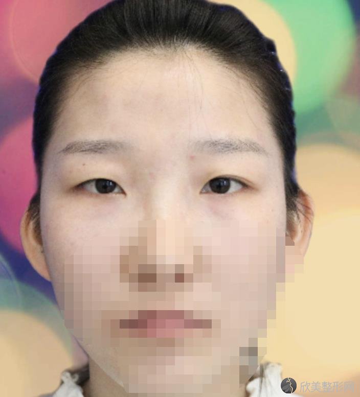 北京禾力康医疗美容医院金尚训医生做双眼皮之前