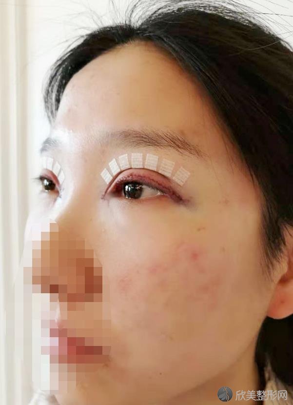 北京禾力康医疗美容医院金尚训医生做双眼皮之后