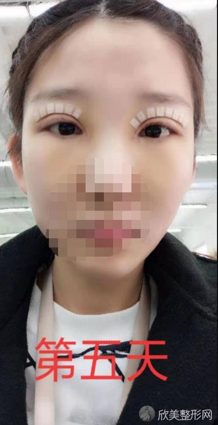 北京禾力康医疗美容医院金尚训医生做双眼皮之后
