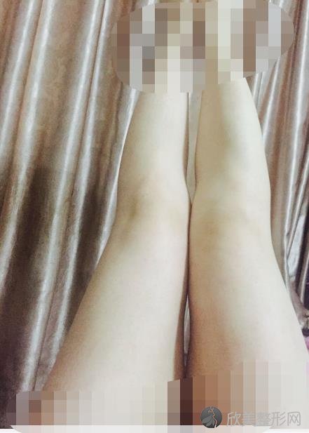 北京华韩整形美容医院谢立宁医生做大腿吸脂之后