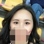 北京华韩整形美容医院余恩旭医生做双眼皮之前