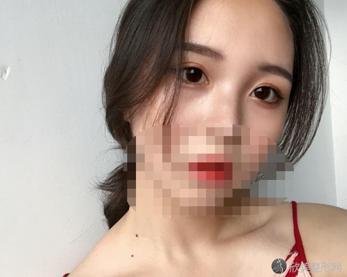 北京华韩整形美容医院余恩旭医生做双眼皮之后