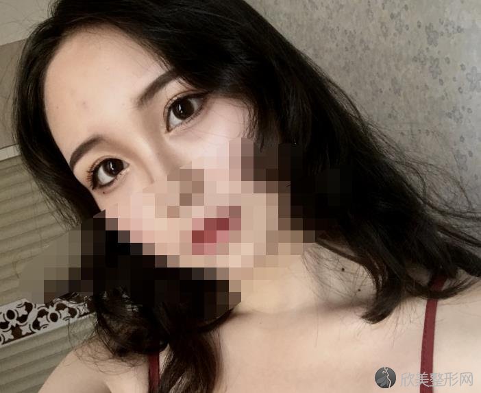 北京华韩整形美容医院余恩旭医生做双眼皮之后