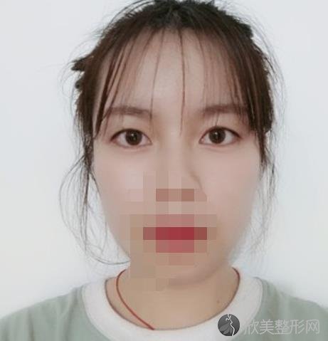北京华韩整形美容医院黄旭培医生做双眼皮之前