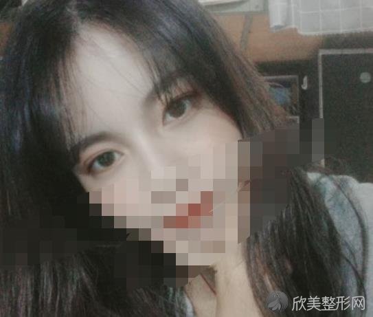 北京华韩整形美容医院黄旭培医生做双眼皮之后