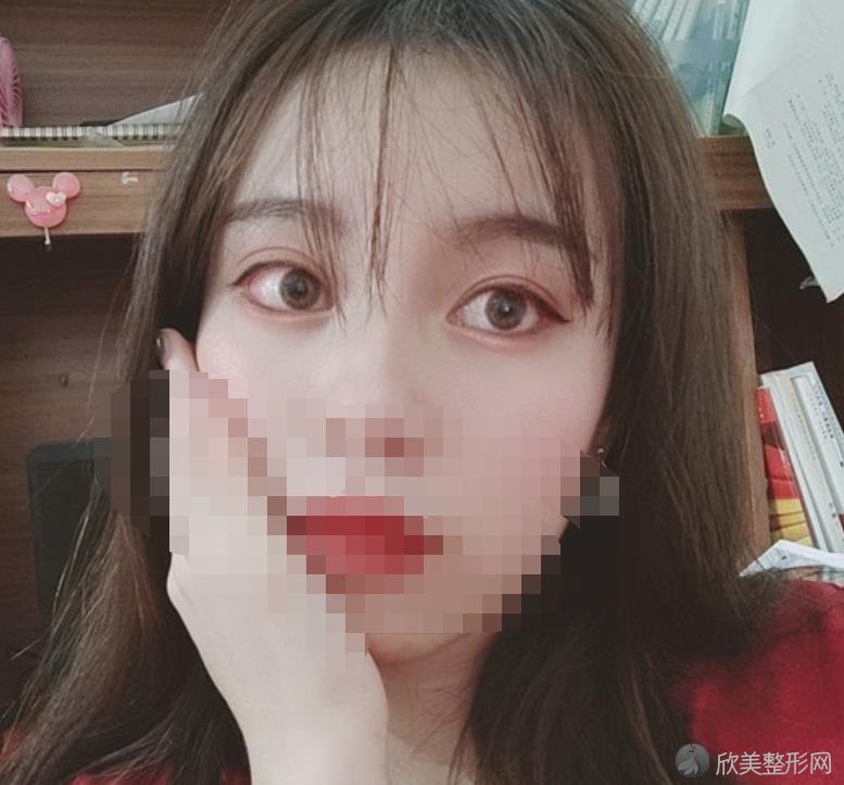北京华韩整形美容医院黄旭培医生做双眼皮之后
