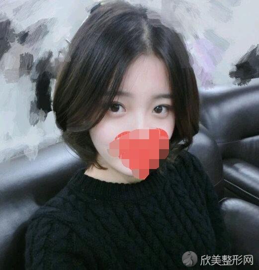 双眼皮术后20天