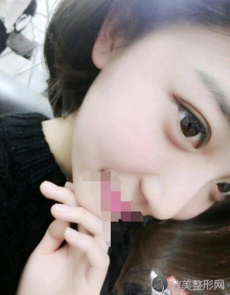 双眼皮术后30天