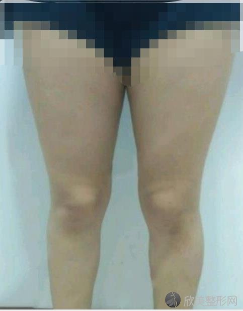 北京东方和谐整形美容医院常双明医生做大腿吸脂之前