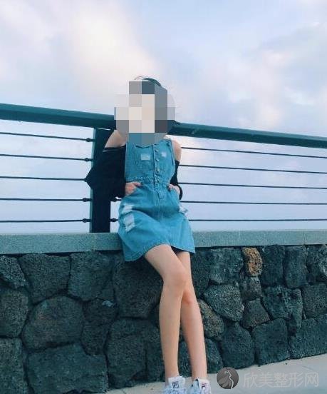 北京润美玉之光整形美容医院王明利医生做大腿吸脂之后