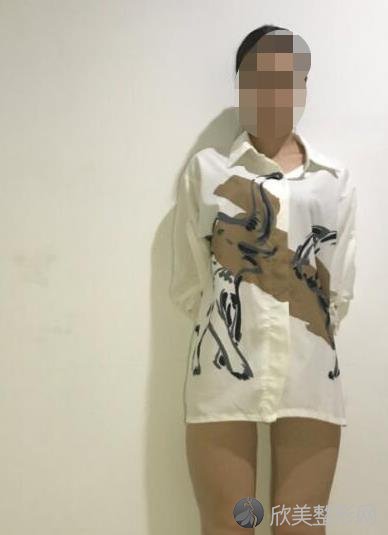 北京润美玉之光整形美容医院王明利医生做大腿吸脂之前