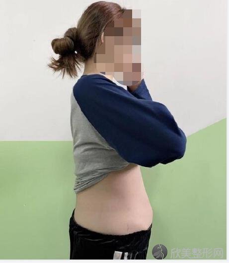 北京润美玉之光整形美容医院张红芳医生做腰腹吸脂之前