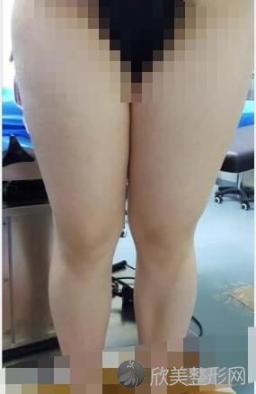 北京润美玉之光整形美容医院朱金成医生做大腿吸脂之前