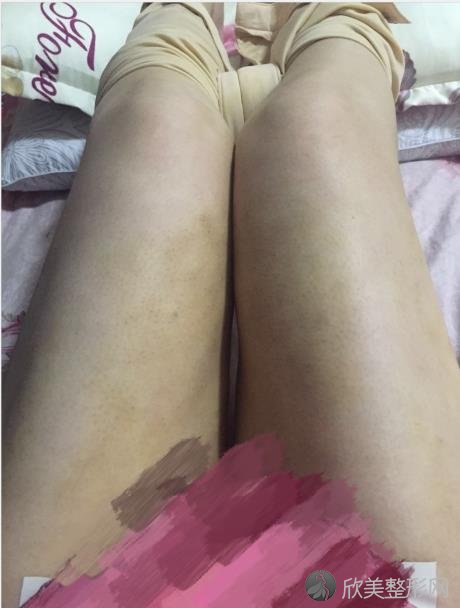 北京润美玉之光整形美容医院朱金成医生做大腿吸脂之后