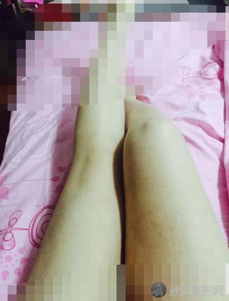 北京润美玉之光整形美容医院朱金成医生做大腿吸脂之后