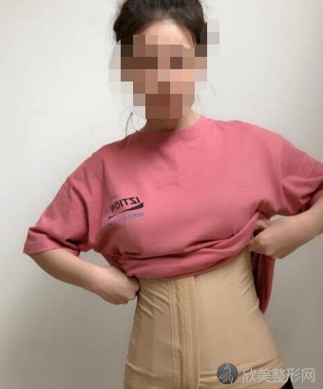 北京首玺丽格整形美容医院沈波医生做腰腹吸脂之前