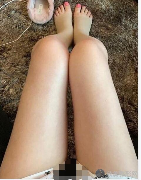 大腿吸脂术后30天