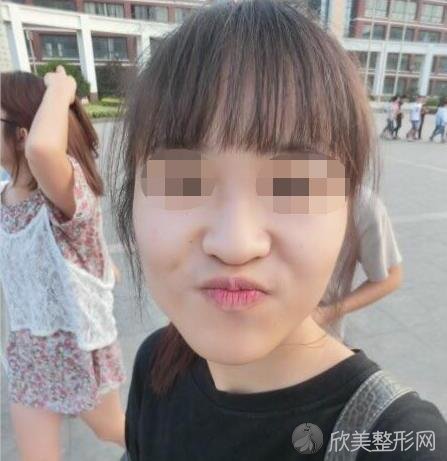 杭州群英整形美容医院做隆鼻之前